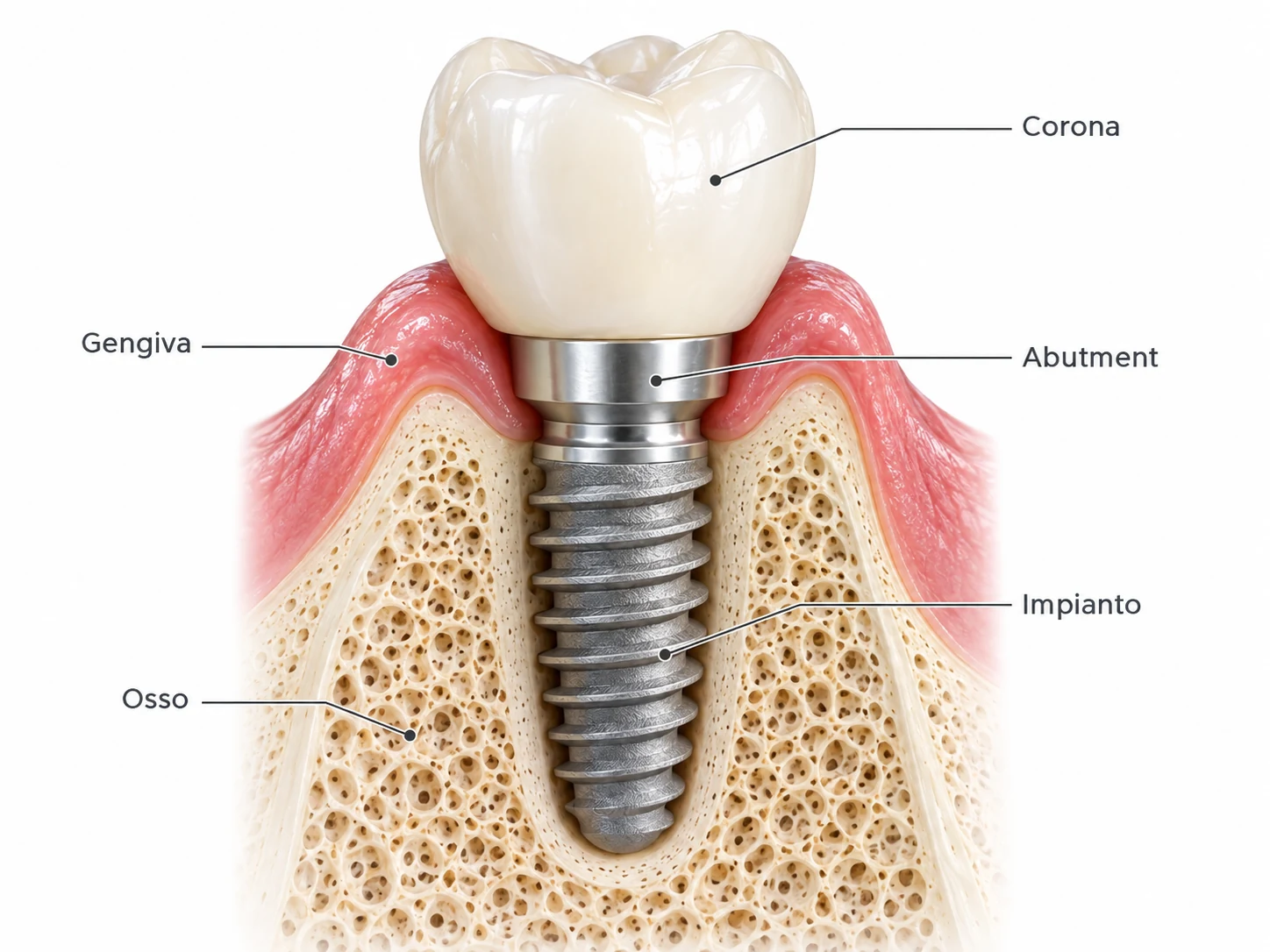 Componenti di un impianto dentale: corona, abutment, impianto, gengiva e osso